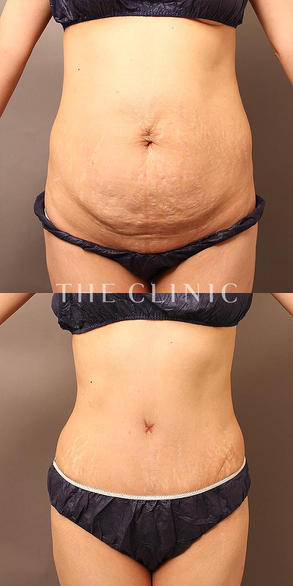 腹部・TWOPACK 陰影ある腹部のタミータック4D(お腹のたるみ解消)（48歳女性）の術前・術後写真