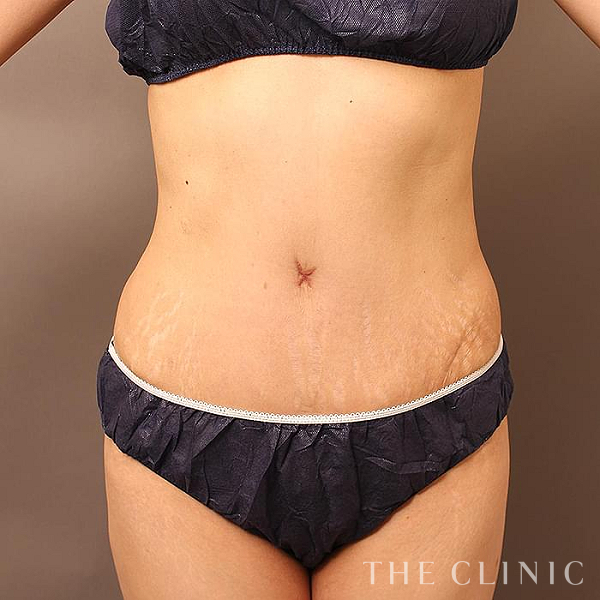 腹部・TWOPACK 陰影ある腹部のタミータック4D(お腹のたるみ解消)（48歳女性）の術後写真