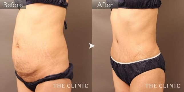 産後の腹部脂肪吸引の症例写真(タミータック)