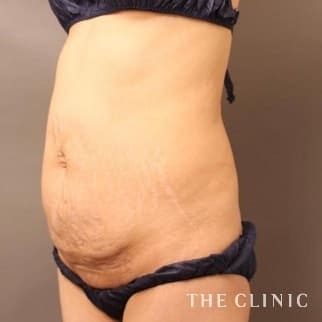 【THE CLINIC 症例画像】No.647_1_腹部_タミータック4D(お腹のたるみ解消)(執刀医:大橋 昌敬)