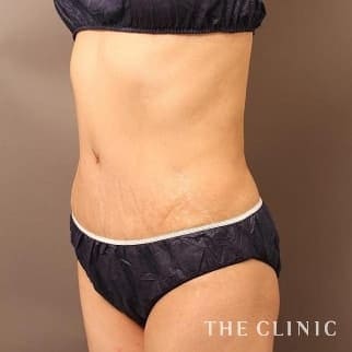 【THE CLINIC 症例画像】No.647_2_腹部_タミータック4D(お腹のたるみ解消)(執刀医:大橋 昌敬)