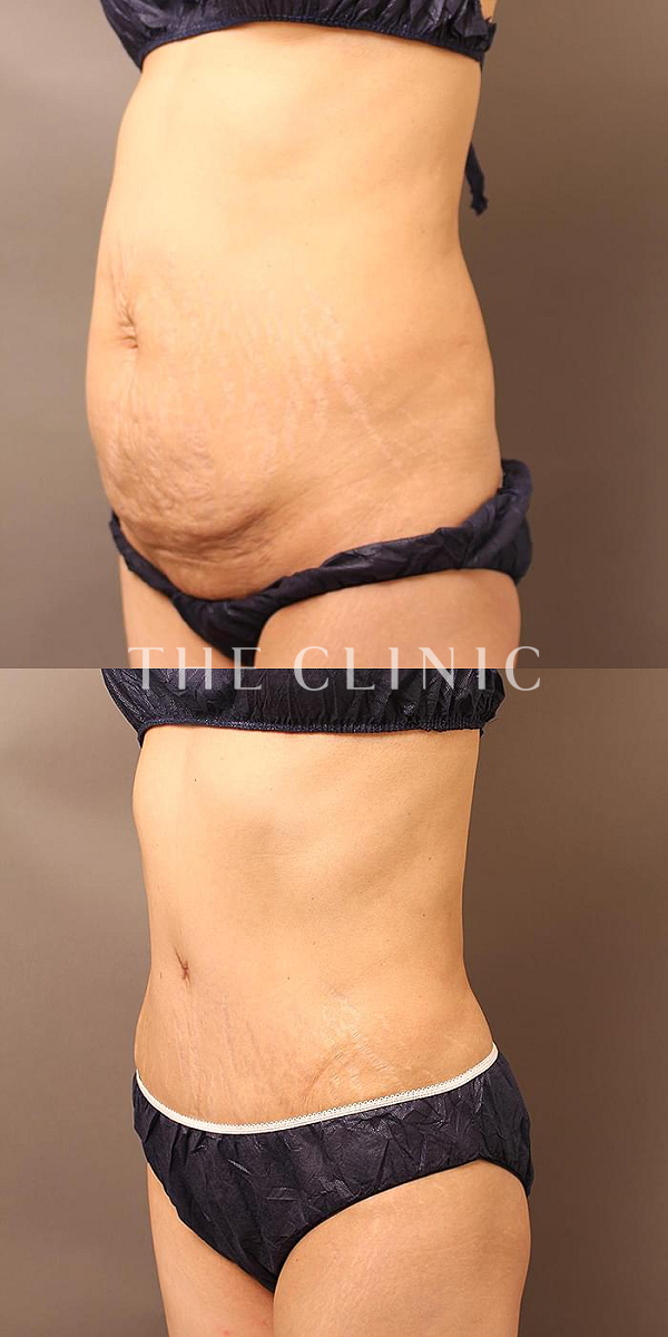 腹部・TWOPACK 陰影ある腹部のタミータック4D(お腹のたるみ解消)（48歳女性）の術前・術後写真