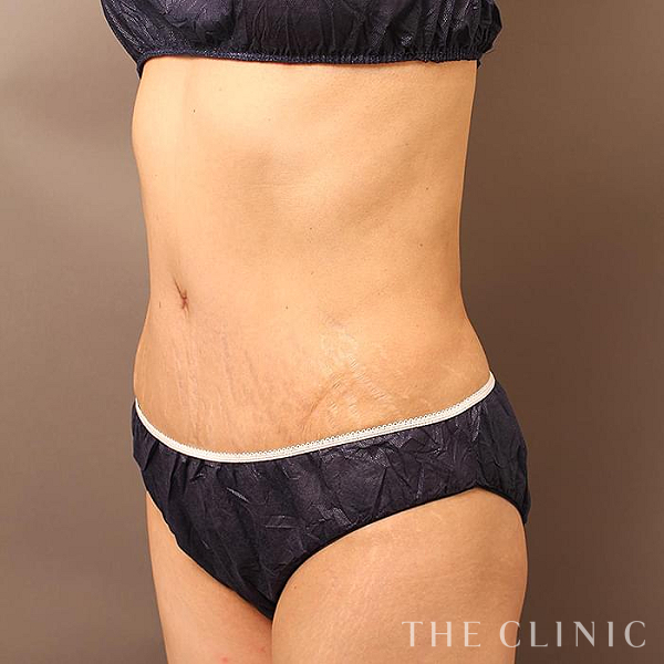 腹部・TWOPACK 陰影ある腹部のタミータック4D(お腹のたるみ解消)（48歳女性）の術後写真