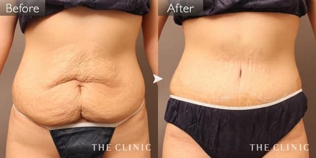 産後の腹部脂肪吸引の症例写真(タミータック)