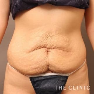 【THE CLINIC 症例画像】No.655_1_腹部_タミータック4D(お腹のたるみ解消)(執刀医：大橋 昌敬)