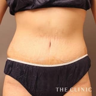 【THE CLINIC 症例画像】No.655_2_腹部_タミータック4D(お腹のたるみ解消)(執刀医:大橋 昌敬)