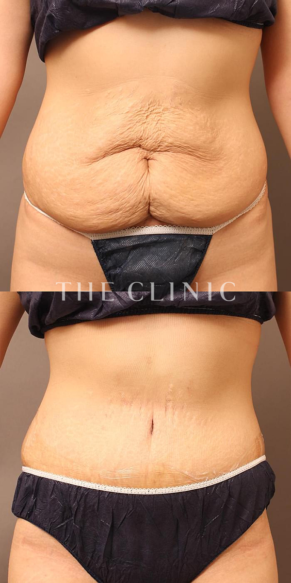 腹部のタミータック4D(お腹のたるみ解消)（28歳女性）の術前・術後写真