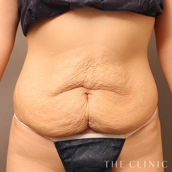 腹部のタミータック4D(お腹のたるみ解消)（28歳女性）の術前写真