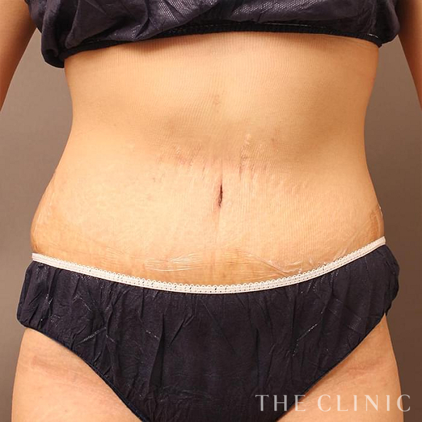 腹部のタミータック4D(お腹のたるみ解消)（28歳女性）の術後写真