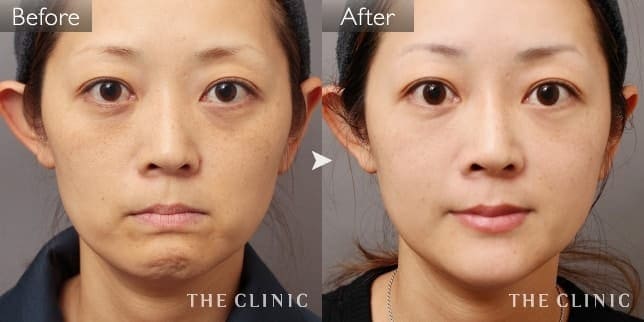 目の下のクマ（女性／41歳）