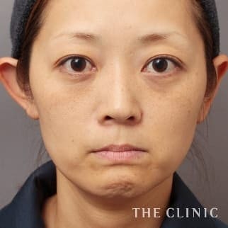 【THE CLINIC 症例画像】No.659_1_目の下のクマ_SRF注入(顔の脂肪注入)(執刀医:大橋 昌敬)