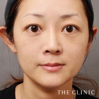 【THE CLINIC 症例画像】No.659_2_目の下のクマ_SRF注入(顔の脂肪注入)(執刀医：大橋 昌敬)
