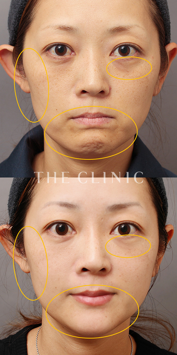 目の下のクマ・こめかみ・こけた頬のSRF注入(顔の脂肪注入)（41歳女性）の術前・術後写真