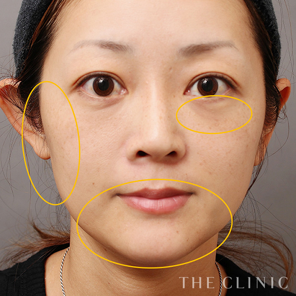 目の下のクマ・こめかみ・こけた頬のSRF注入(顔の脂肪注入)（41歳女性）の術後写真