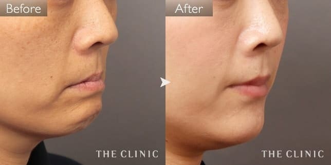 エイジング治療 目の上のくぼみ/目の下のクマ/こけた頬/法令線/マリオネットライン/唇のシワ/顎のライン 症例写真