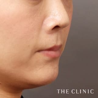 【THE CLINIC 症例画像】No.660_2_目の上のくぼみ_SRF注入(顔の脂肪注入)(執刀医:大橋 昌敬)