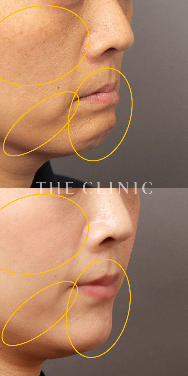 目の上のくぼみ・目の下のクマ・こけた頬・法令線・マリオネットライン・唇のシワ・顎のラインのSRF注入(顔の脂肪注入)（41歳女性）の術前・術後写真