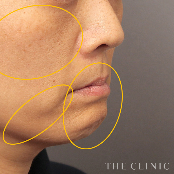 目の上のくぼみ・目の下のクマ・こけた頬・法令線・マリオネットライン・唇のシワ・顎のラインのSRF注入(顔の脂肪注入)（41歳女性）の術前写真