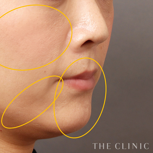 目の上のくぼみ・目の下のクマ・こけた頬・法令線・マリオネットライン・唇のシワ・顎のラインのSRF注入(顔の脂肪注入)（41歳女性）の術後写真