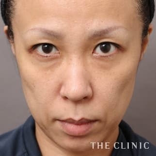 【THE CLINIC 症例画像】No.669_1_目の下のクマ_SRF注入(顔の脂肪注入)(執刀医:大橋 昌敬)