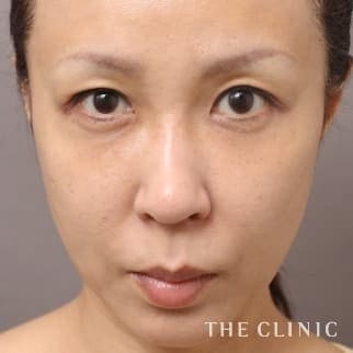 【THE CLINIC 症例画像】No.669_2_目の下のクマ_SRF注入(顔の脂肪注入)(執刀医:大橋 昌敬)