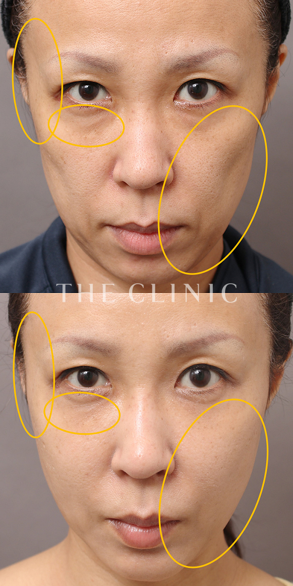 目の下のクマ・こめかみ・こけた頬・法令線・おでこ(額)のくぼみのSRF注入(顔の脂肪注入)（45歳女性）の術前・術後写真