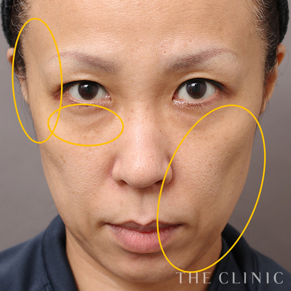 目の下のクマ・こめかみ・こけた頬・法令線・おでこ(額)のくぼみのSRF注入(顔の脂肪注入)（45歳女性）の術前写真