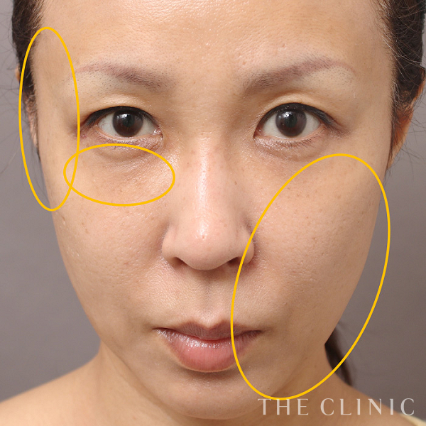 目の下のクマ・こめかみ・こけた頬・法令線・おでこ(額)のくぼみのSRF注入(顔の脂肪注入)（45歳女性）の術後写真