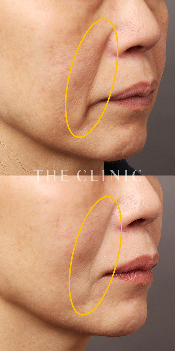 法令線のマイクロCRF注入(顔の脂肪注入)（58歳女性）の術前・術後写真