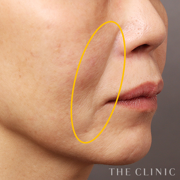 法令線のマイクロCRF注入(顔の脂肪注入)（58歳女性）の術後写真