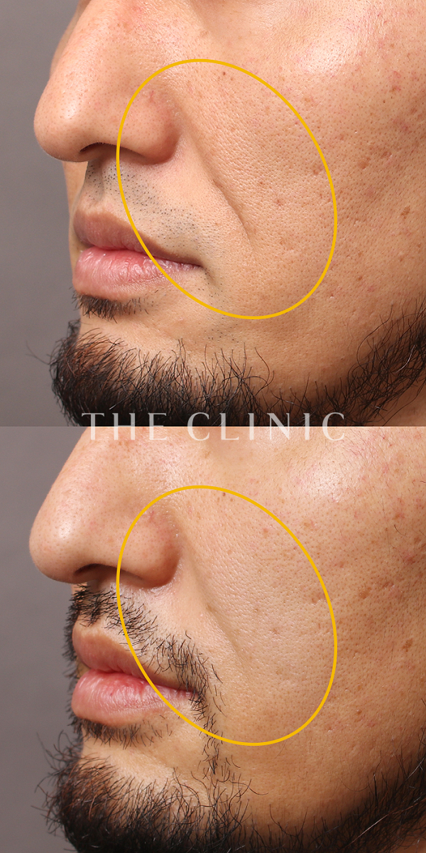 法令線のコンデンスリッチフェイス(顔の脂肪注入)（37歳男性）の術前・術後写真