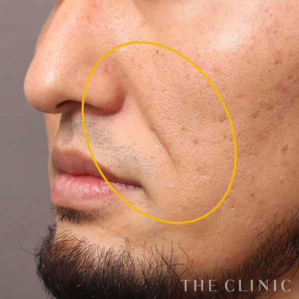 法令線のコンデンスリッチフェイス(顔の脂肪注入)（37歳男性）の術前写真