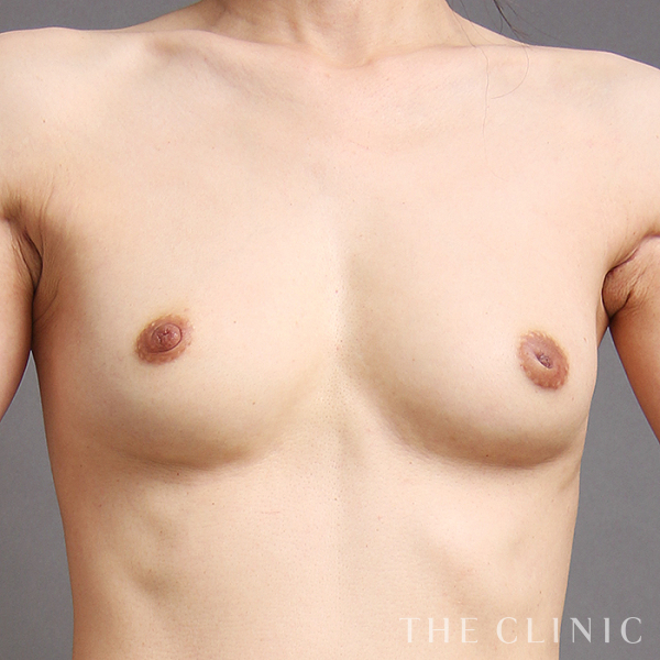 シリコンバッグ抜去の豊胸シリコンバッグ除去（47歳女性）の術後写真