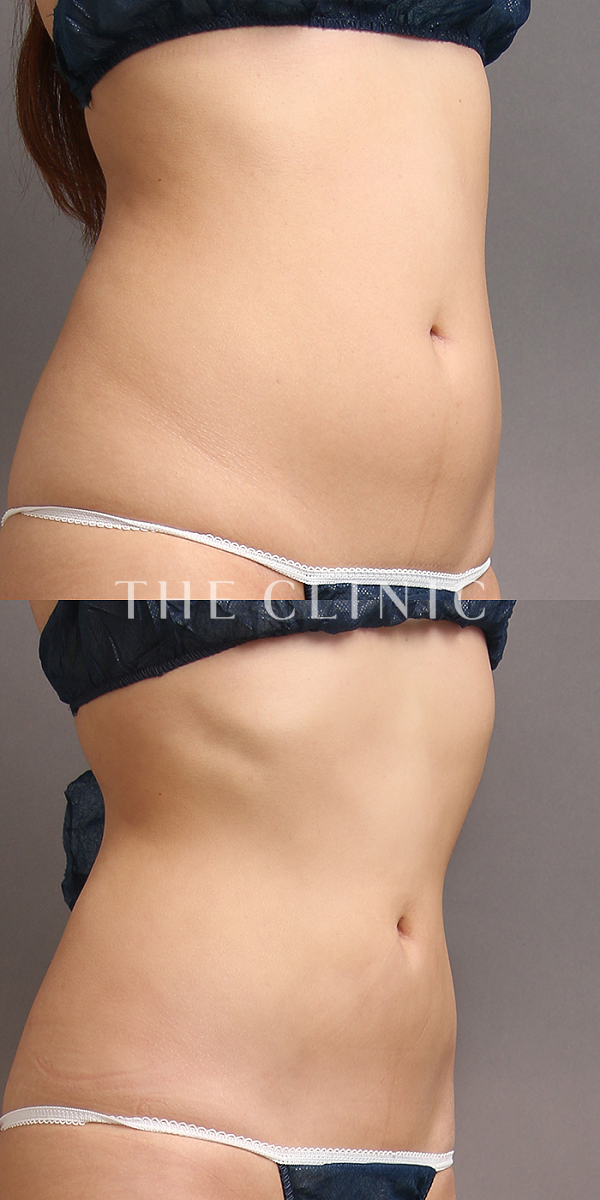 腹部のベイザー脂肪吸引（23歳女性）の術前・術後写真
