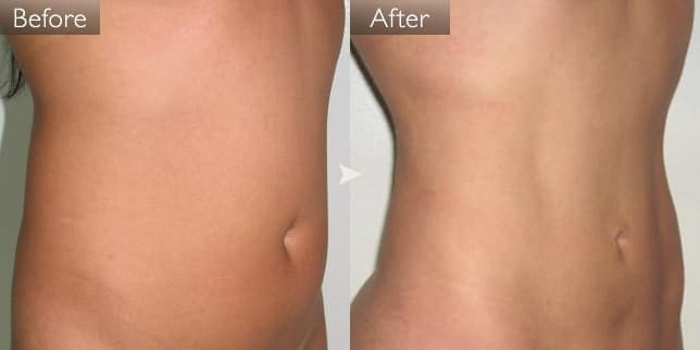 TWOPACK 陰影ある腹部（女性／33歳）