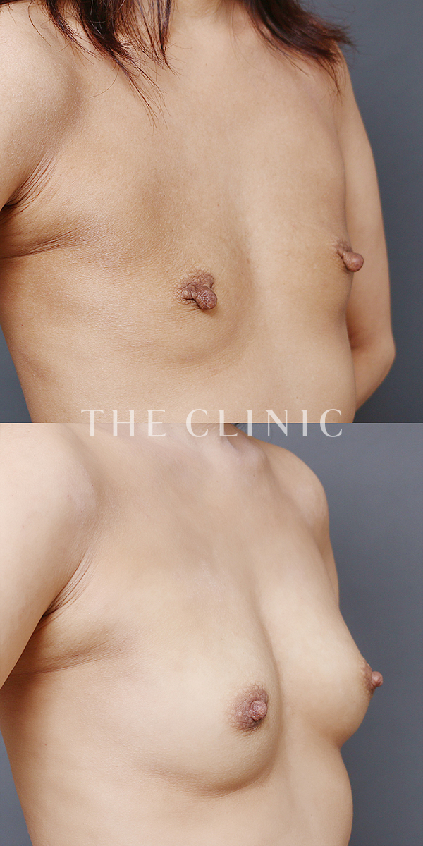 ボリュームアップのコンデンスリッチ豊胸（43歳女性）の術前・術後写真