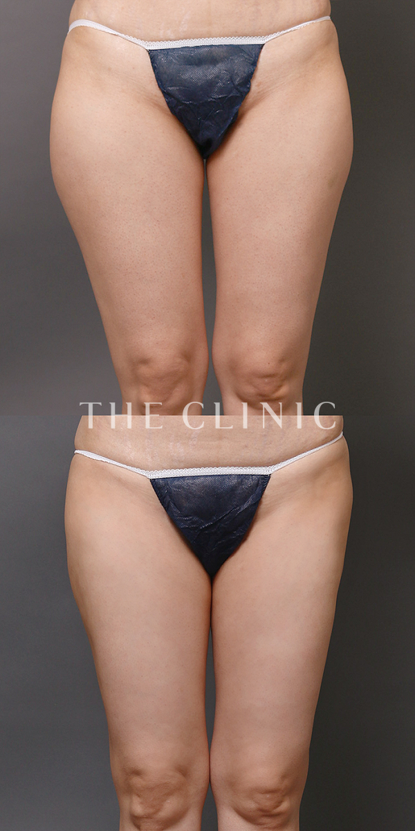 太もものベイザー脂肪吸引（43歳女性）の術前・術後写真