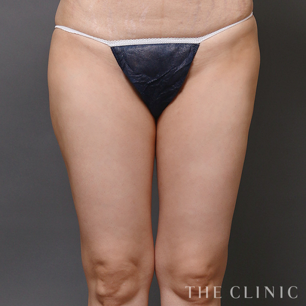 太もものベイザー脂肪吸引（43歳女性）の術後写真