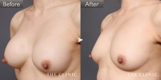 シリコンバッグ抜去(女性/52歳)