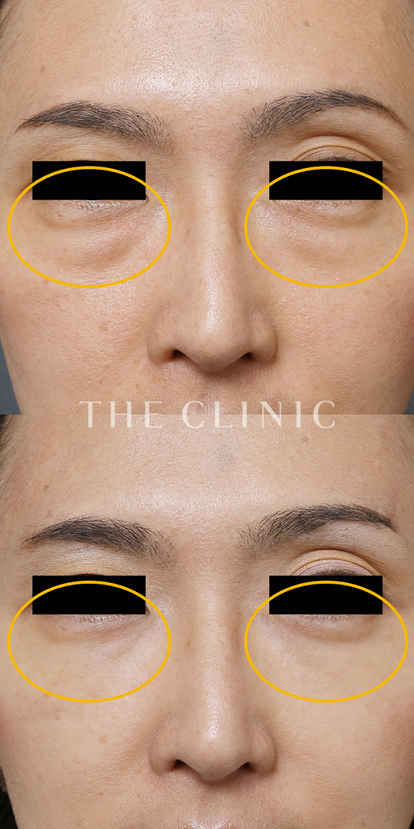 目の下のクマのマイクロCRF注入(顔の脂肪注入)（38歳女性）の術前・術後写真