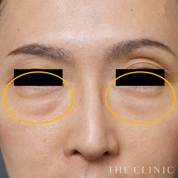 目の下のクマのマイクロCRF注入(顔の脂肪注入)（38歳女性）の術前写真