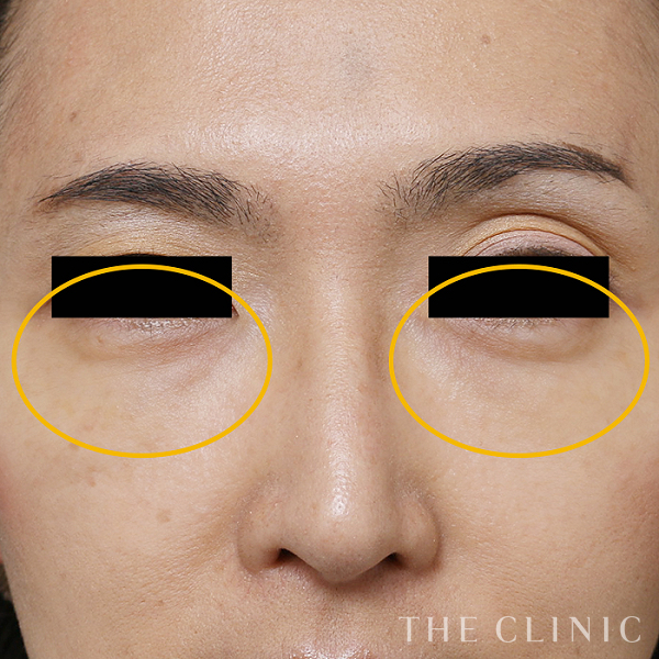 目の下のクマのマイクロCRF注入(顔の脂肪注入)（38歳女性）の術後写真