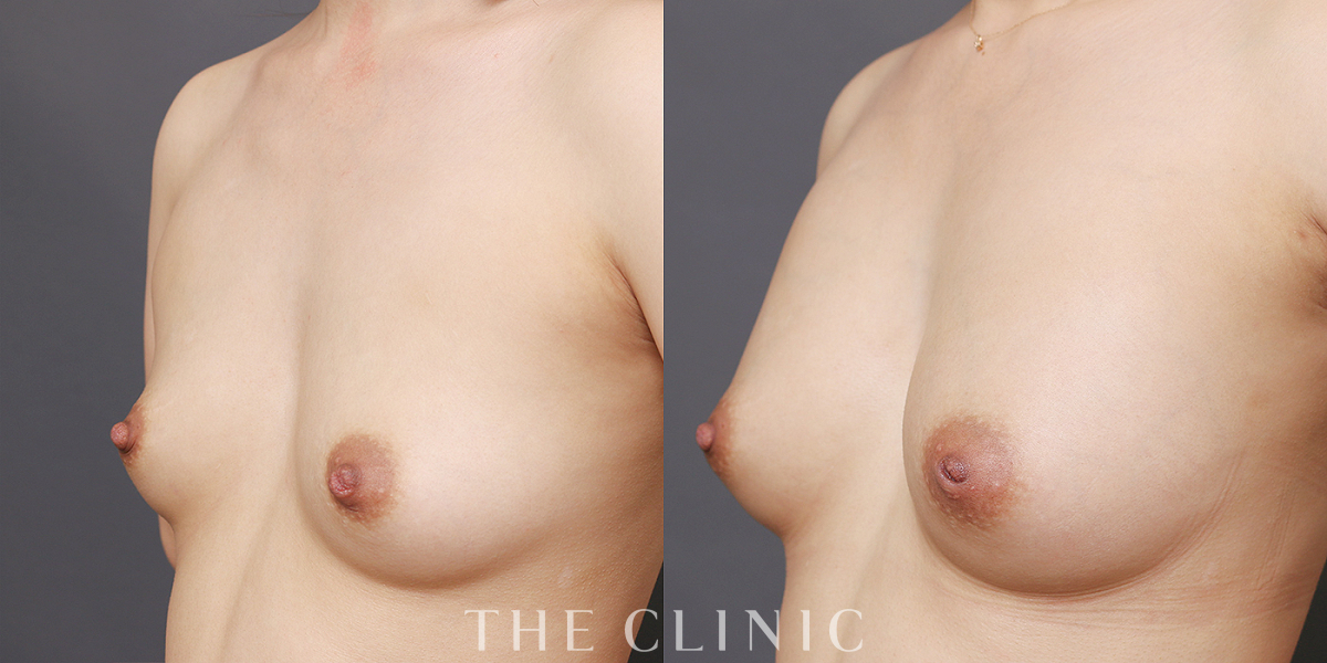 コンデンスリッチ豊胸の術前/術後