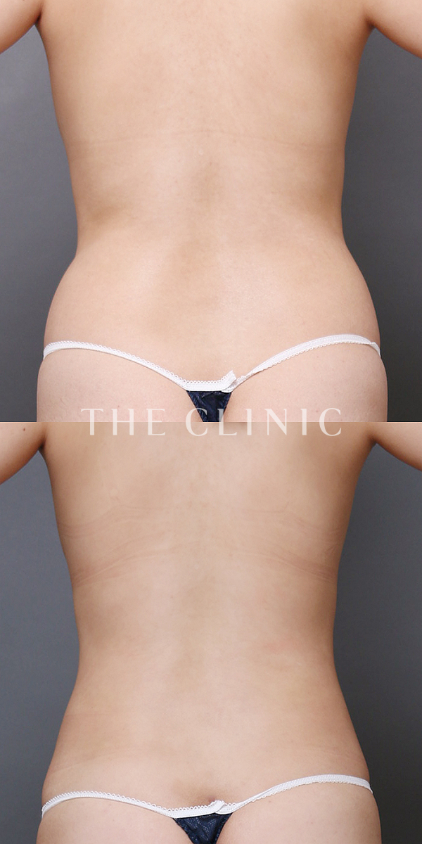 腰・ウエストのベイザー脂肪吸引（27歳女性）の術前・術後写真