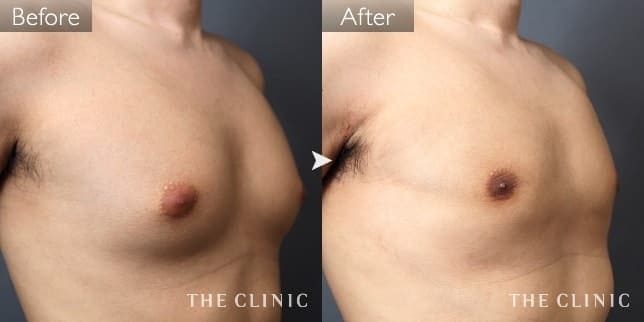 女性化乳房（男性／29歳）