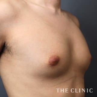女性化乳房の女性化乳房治療(男性の胸の膨らみ改善)のモニター(20代)術前症例画像