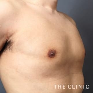 女性化乳房の女性化乳房治療(男性の胸の膨らみ改善)のモニター（20代）術後症例画像