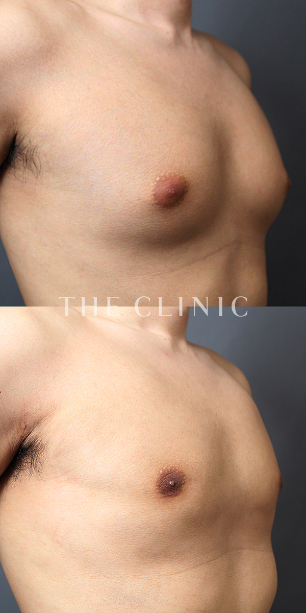 女性化乳房の女性化乳房治療(男性の胸の膨らみ改善)（29歳男性）の術前・術後写真