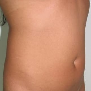 【THE CLINIC 症例画像】No.68_1_TWOPACK 陰影ある腹部_4D脂肪吸引(4Dリポ)(執刀医:)