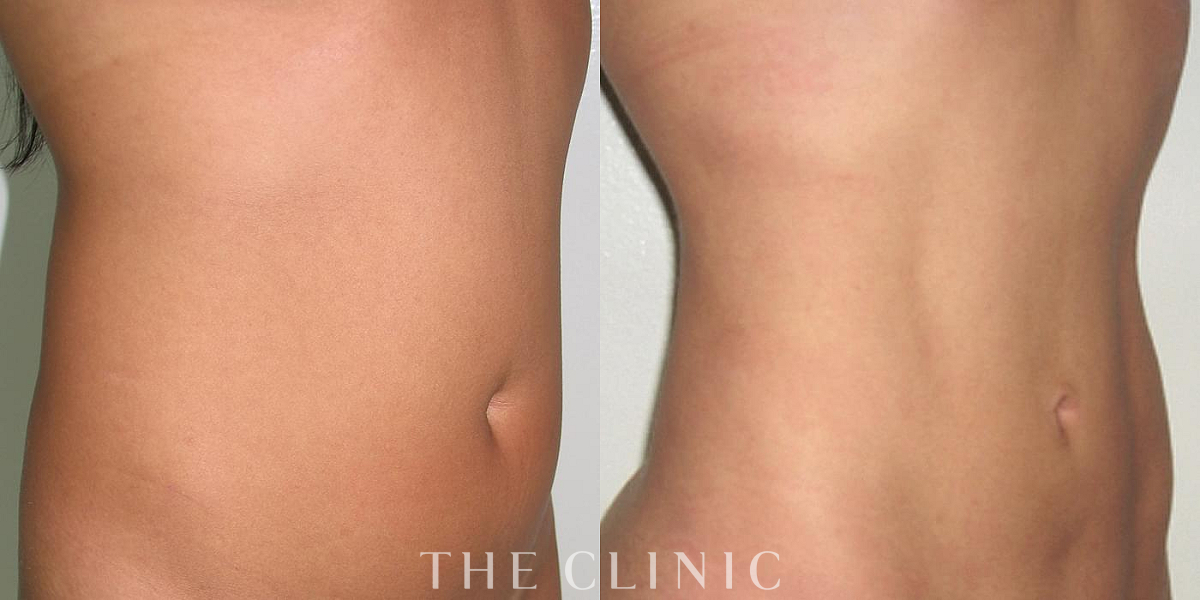 4D脂肪吸引(4Dリポ)の術前／術後